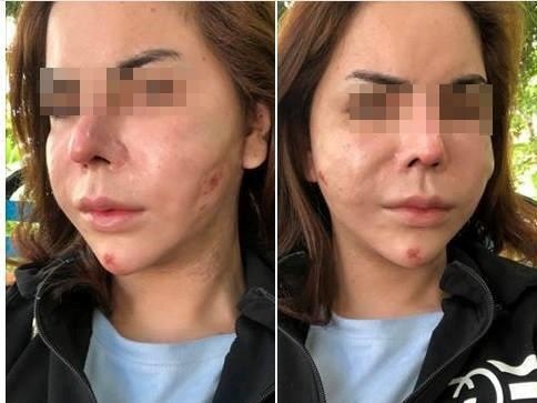 5 co gai bi tai bien do phau thuat tham my trong nam 2017 hinh anh