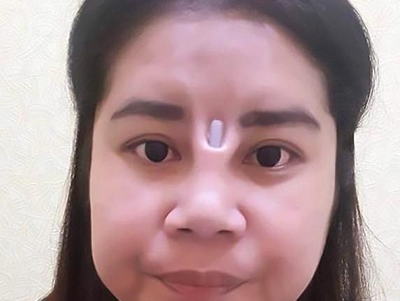 Nhung bien chung do nang mui va cach khac phuc hinh anh