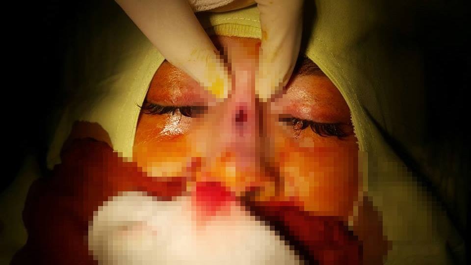 Cô gái bị thủng mũi do thẩm mỹ ảnh 1 Co gai bi thung mui do tham my anh 1