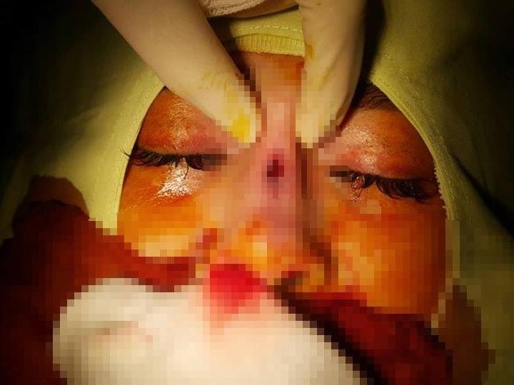 Co gai thung mui sau khi 'dao keo' hinh anh