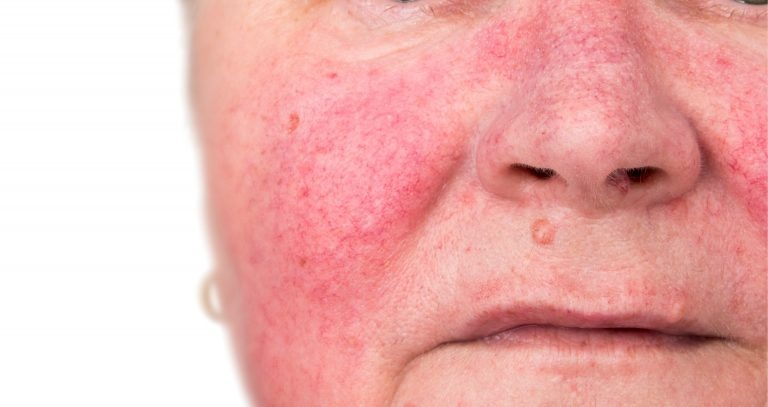 Thay da sinh học ảnh 2 Thay da sinh hoc anh 2