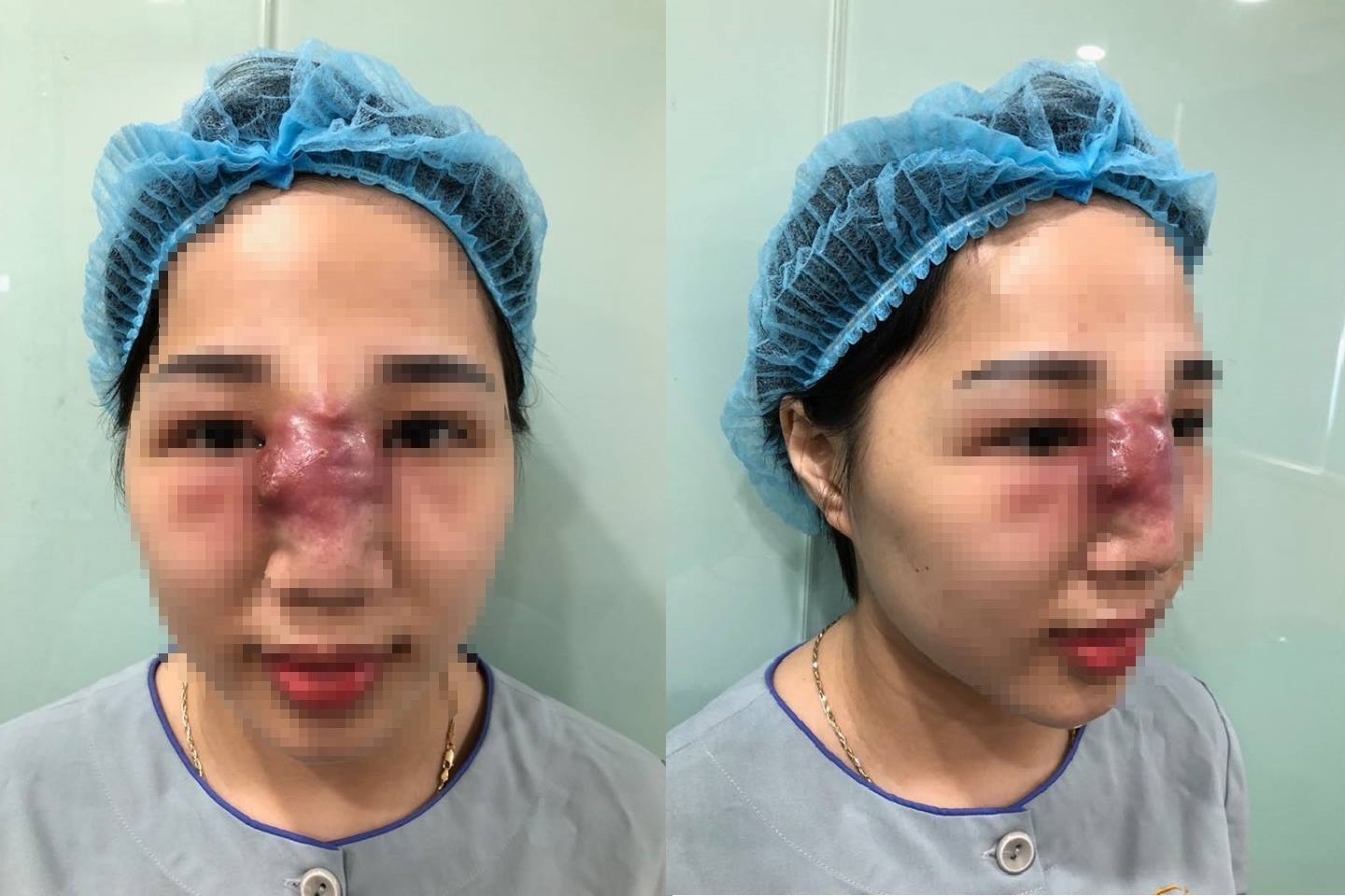 Mũi mưng mủ,  hoại tử do tiêm filler ảnh 1 Mui mung mu,  hoai tu do tiem filler anh 1