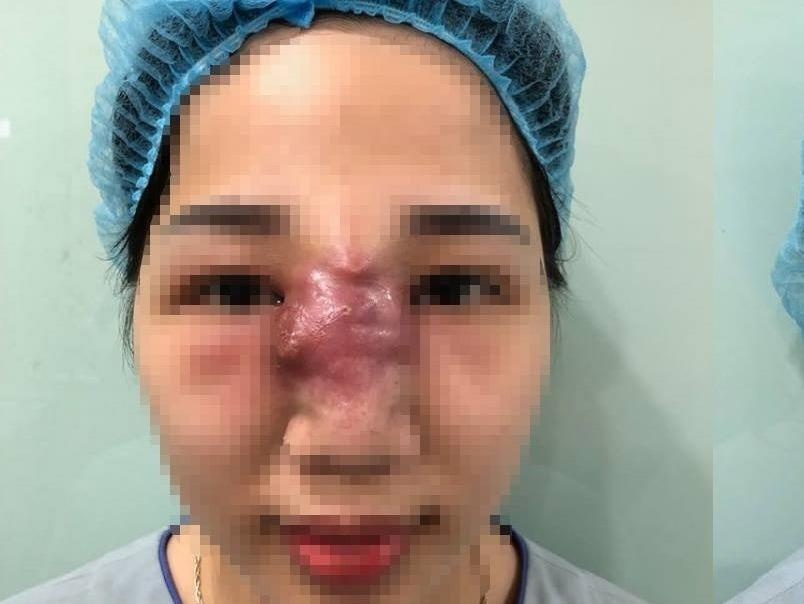 Mui mung mu sau khi tiem filler tai spa hinh anh