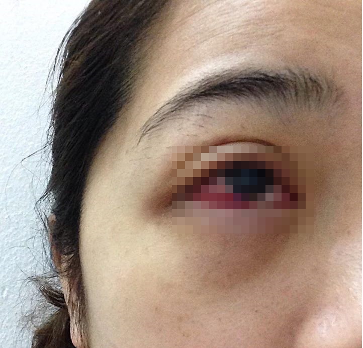 Nhiễm trùng mắt vì nối mi giả ảnh 1 Nhiem trung mat vi noi mi gia anh 1