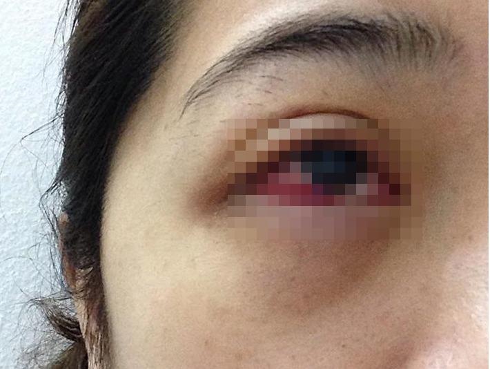 Co gai nhiem trung mat do noi mi gia hinh anh