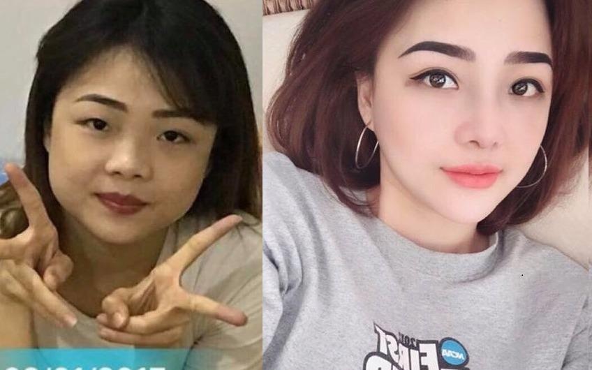 9X mat mot mi xinh nhu hot girl sau khi 'dao keo' hinh anh
