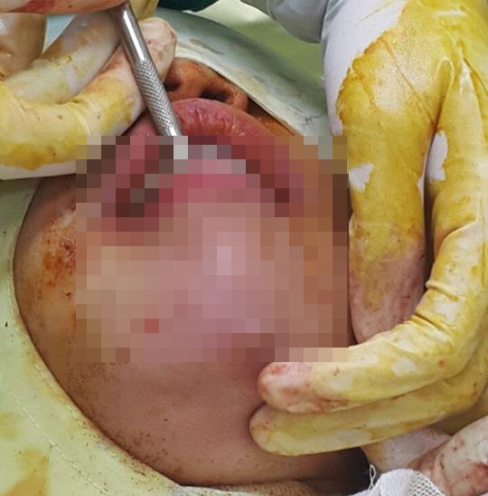 Biến chứng do tiêm filler ảnh 1 Bien chung do tiem filler anh 1