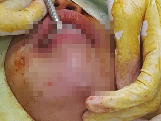 Co gai phai nao cam vi tiem filler kem chat luong hinh anh