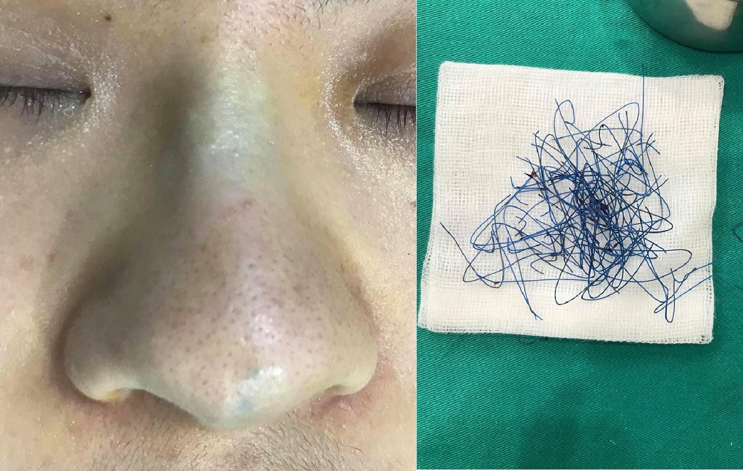 búi chỉ bằng nylon từ trong mũi cô gái ảnh 1 bui chi bang nylon tu trong mui co gai anh 1