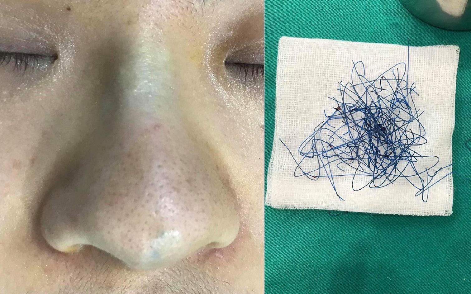 Bac si gap ra bui chi bang nylon tu trong mui co gai hinh anh