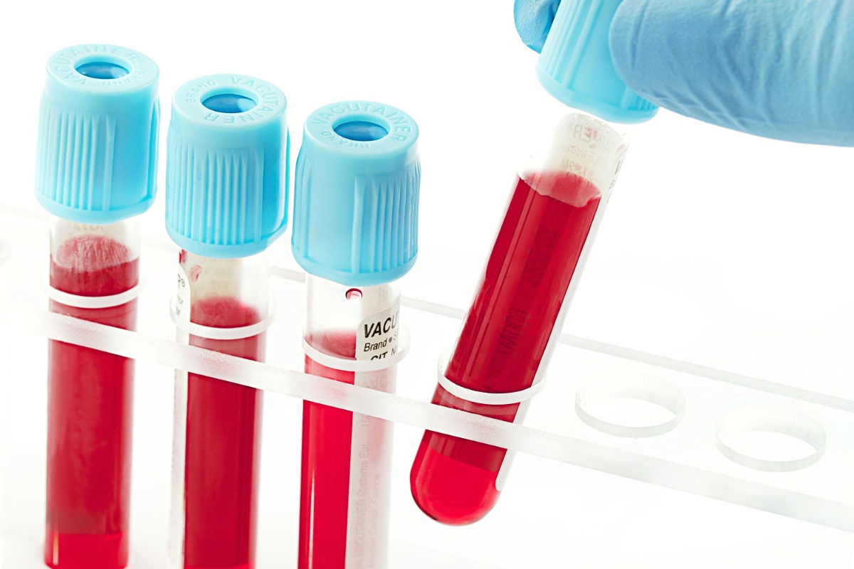 Dấu hiệu ung thư dạ dày ảnh 7 Dau hieu ung thu da day anh 7