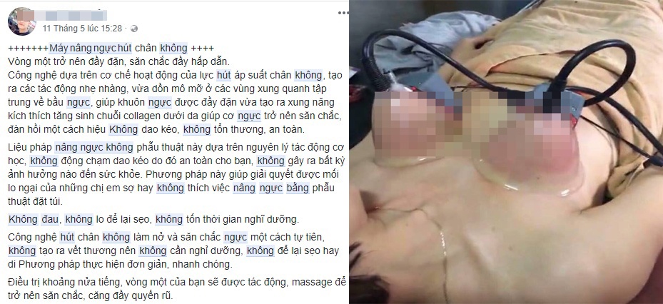 Máy nâng ngực hút chân không ảnh 1 May nang nguc hut chan khong anh 1