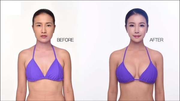 Biến đổi sau phẫu thuật thẩm mỹ ảnh 5 Bien doi sau phau thuat tham my anh 5