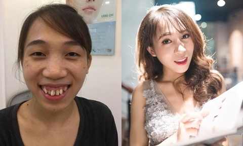 Biến đổi sau phẫu thuật thẩm mỹ ảnh 9 Bien doi sau phau thuat tham my anh 9