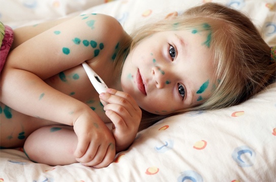 Trẻ bị thủy đậu ảnh 1 Tre bi thuy dau anh 1