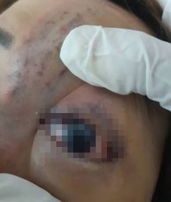 mù mắt vì chất làm đầy ảnh 1 mu mat vi chat lam day anh 1