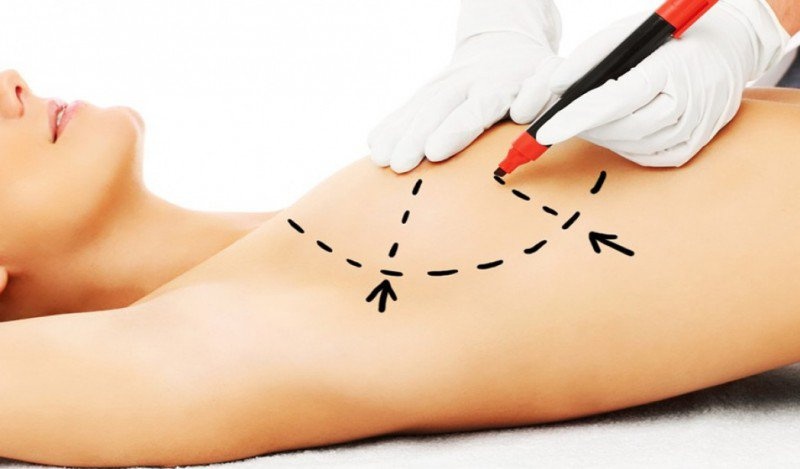 Phẫu thuật thu nhỏ ngực ảnh 3 Phau thuat thu nho nguc anh 3