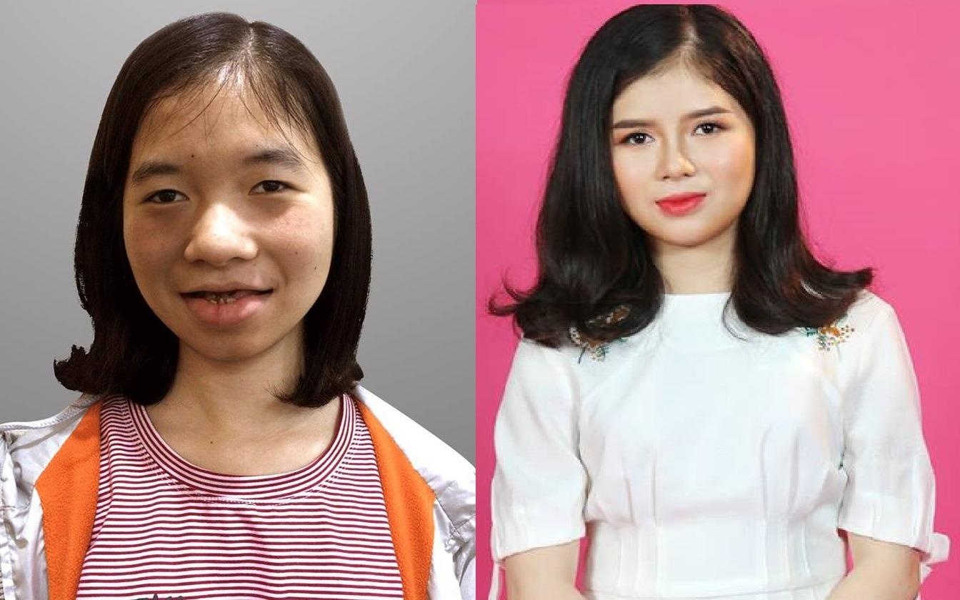 Co gai bi che la 'ma ca rong' lot xac sau 5 lan phau thuat tham my hinh anh