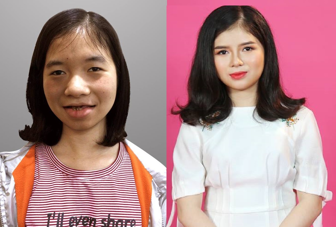 cô gái lột xác sau phẫu thuật thẩm mỹ ảnh 1 co gai lot xac sau phau thuat tham my anh 1