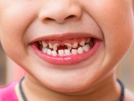 Nhieu loai duong co the gay sau rang du thuc an khong ngot hinh anh