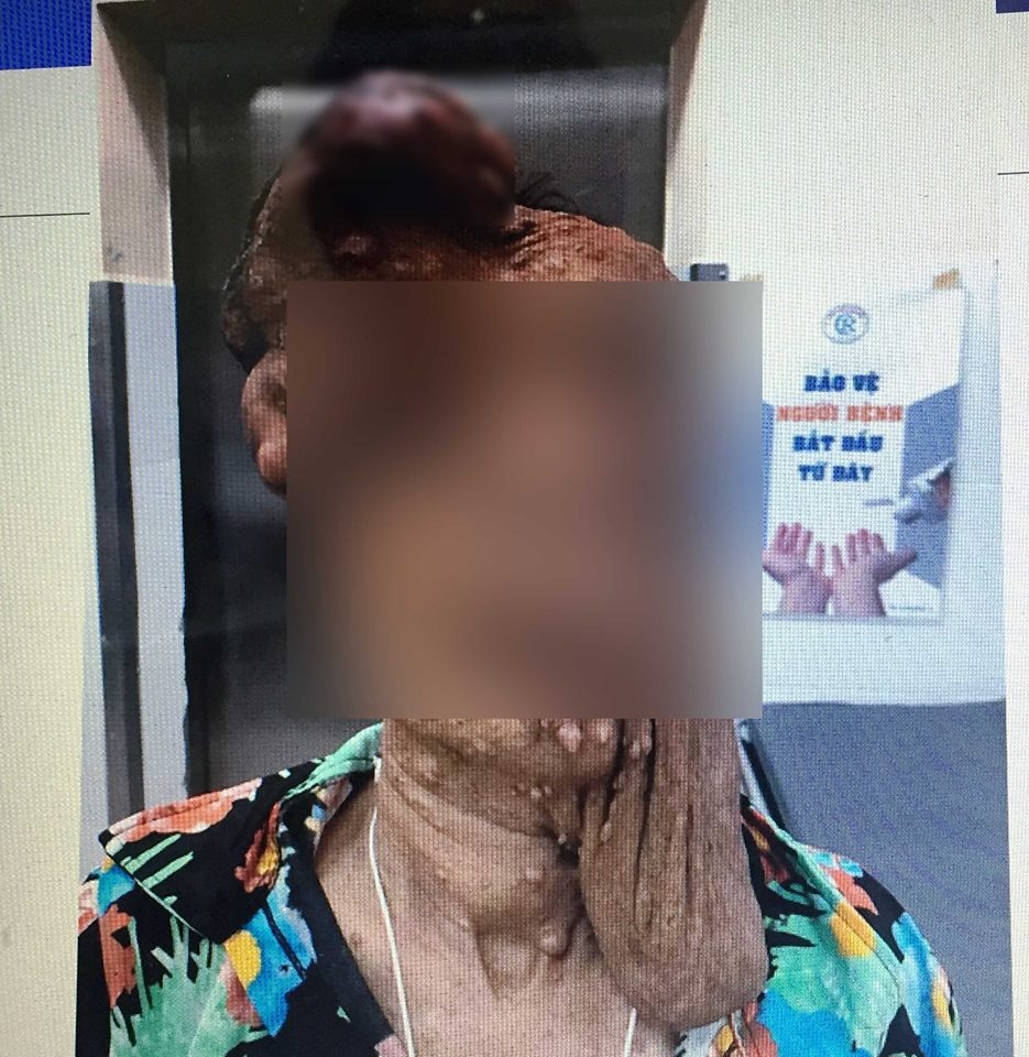 U trên mặt gần 2 kg ảnh 1 U tren mat gan 2 kg anh 1