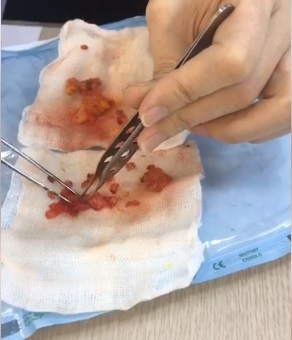 Biến chứng vì tiêm silicone lỏng ảnh 1 Bien chung vi tiem silicone long anh 1