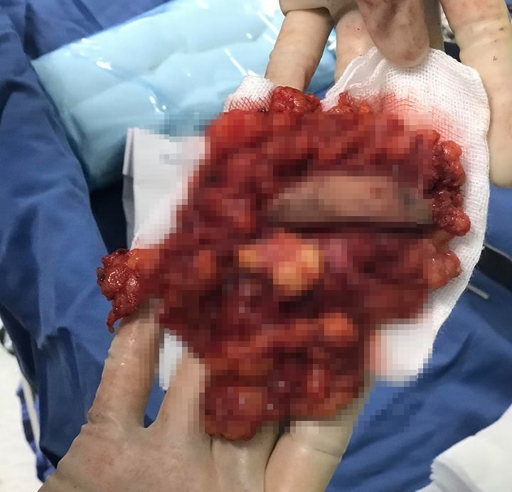 U do tiem silicone long anh 1