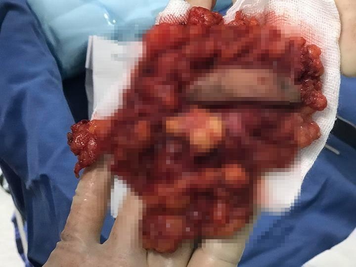 Nao hai khoi u to bang ban tay vi nang mong bang silicone long hinh anh