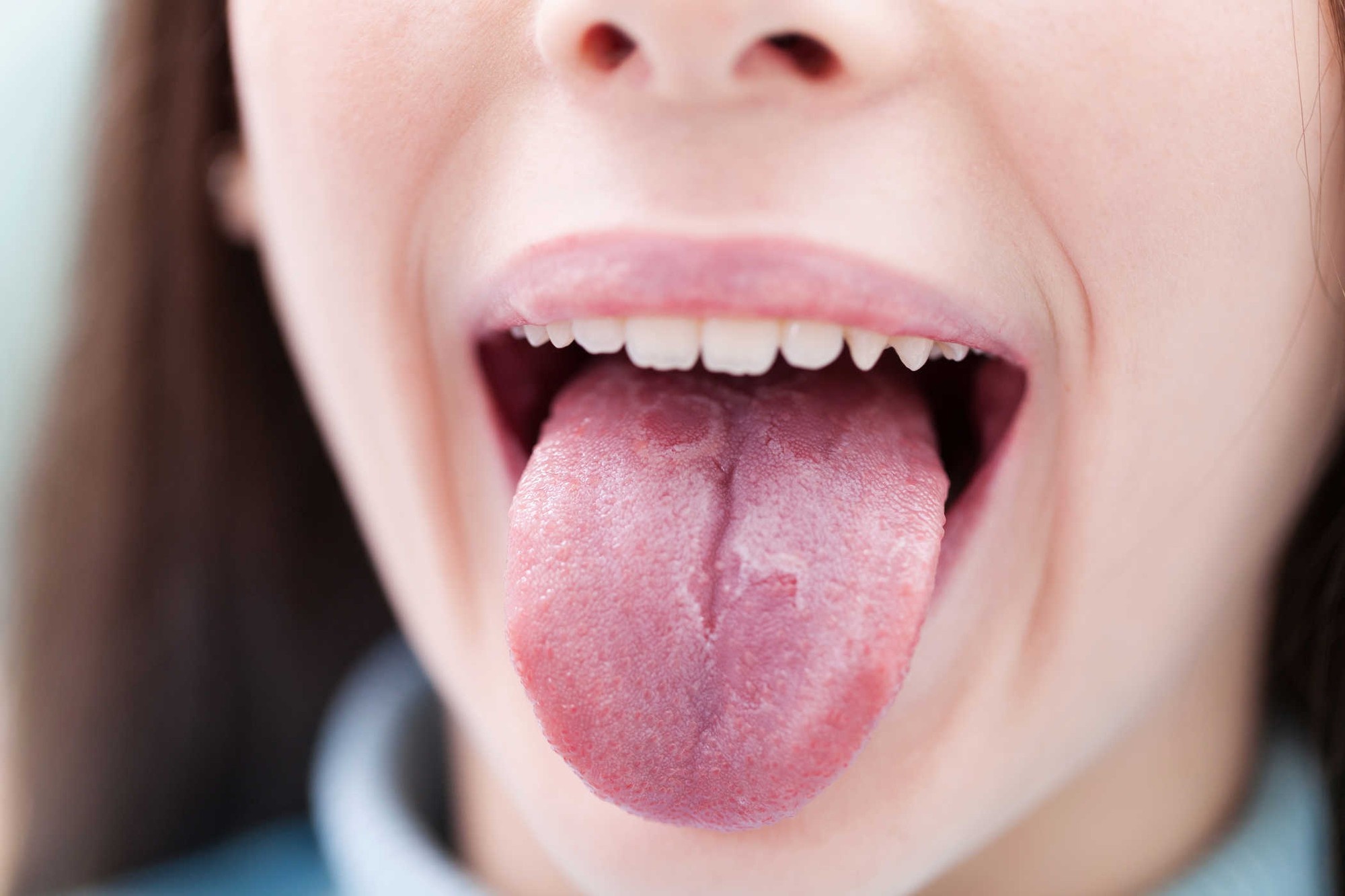 Dấu hiệu ung thư lưỡi ảnh 1 Dau hieu ung thu luoi anh 1