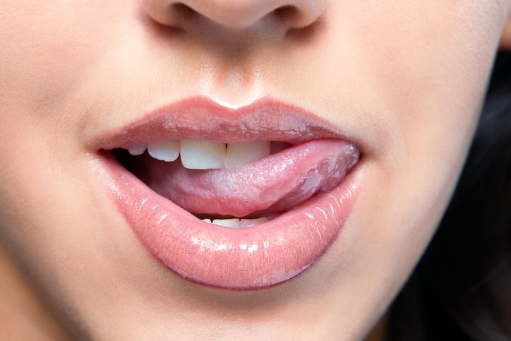 Dấu hiệu ung thư lưỡi ảnh 3 Dau hieu ung thu luoi anh 3