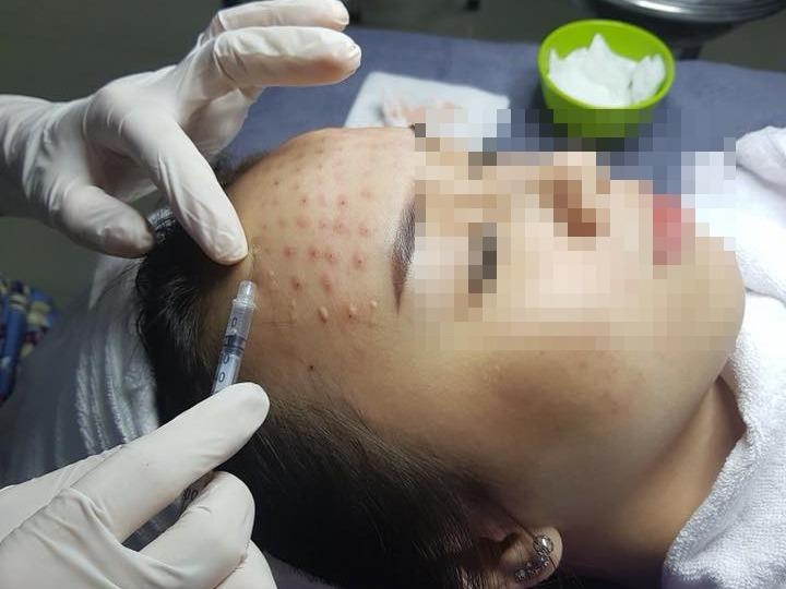 Su that ve cac phuong phap 'cay' tinh chat, lan kim tre hoa da hinh anh