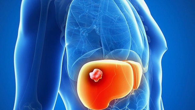 Mặc ung thư do uống rượu ảnh 7 Mac ung thu do uong ruou anh 7