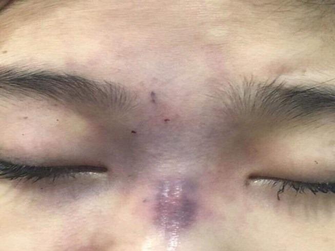 Thuc hanh nghe tham my, chong tiem filler lam mu mat vo hinh anh