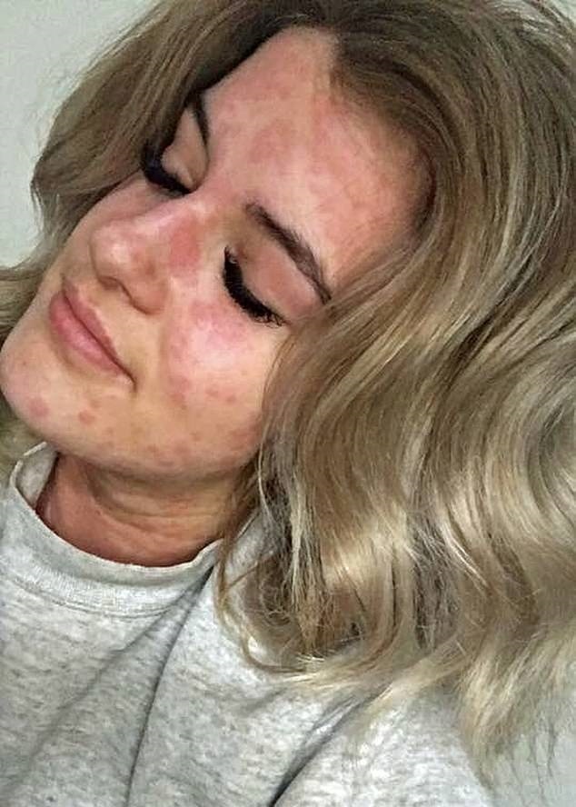 Di ứng ảnh 1 Di ung anh 1