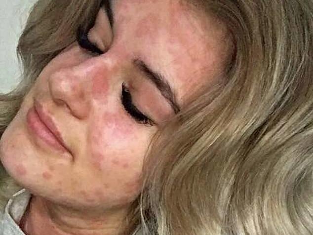 Co gai bi di ung voi mua dong hinh anh