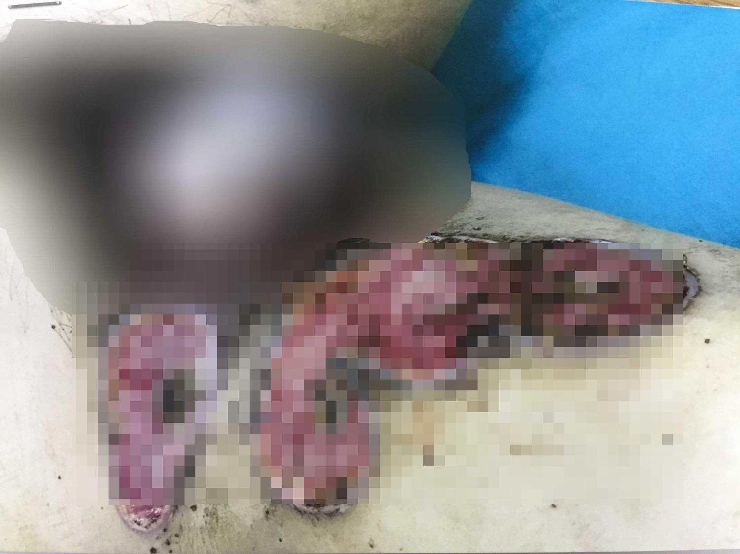 Vet thuong boc mui vi tu y dap thuoc nam chua bong hinh anh