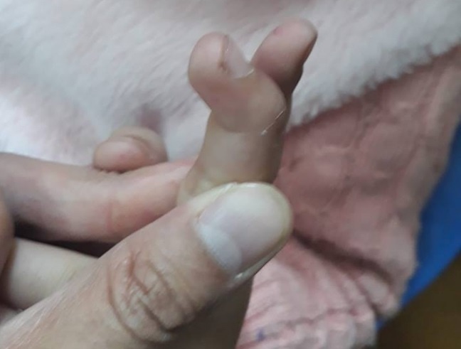 Bé gái đứt gân duỗi ngón tay ảnh 1 Be gai dut gan duoi ngon tay anh 1