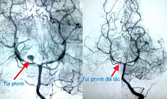 bệnh nhi phình mạch máu não ảnh 1 benh nhi phinh mach mau nao anh 1