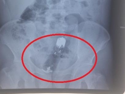 Duong vat gia mac ket trong truc trang nam benh nhan hinh anh