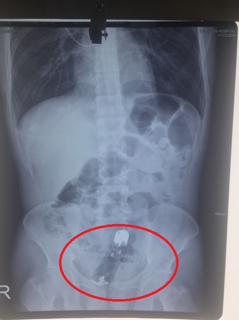 dị vật nằm sâu trong hậu môn nam bệnh nhân ảnh 1 di vat nam sau trong hau mon nam benh nhan anh 1