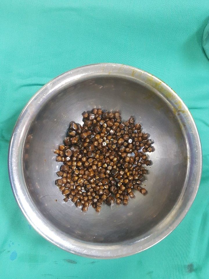 400 vien soi trong tui mat anh 1