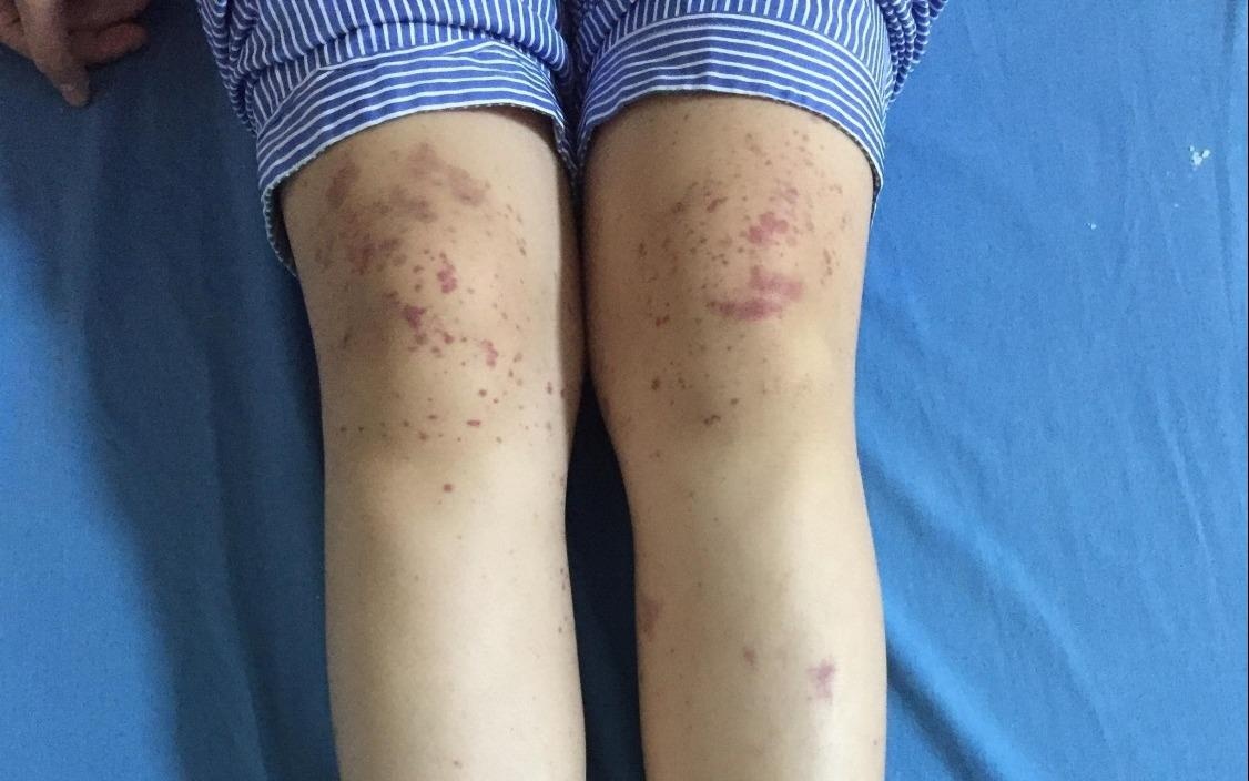 Benh nhi xuat huyet, non ra mau vi can benh thuong gap trong mua dong hinh anh