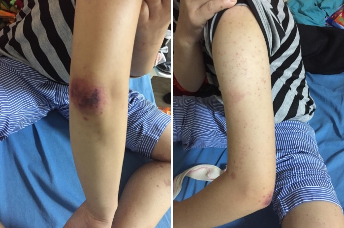 viem mao mach di ung anh 1