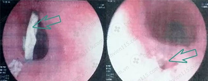 suýt mất mạng vì hóc xương gà ảnh 1 suyt mat mang vi hoc xuong ga anh 1