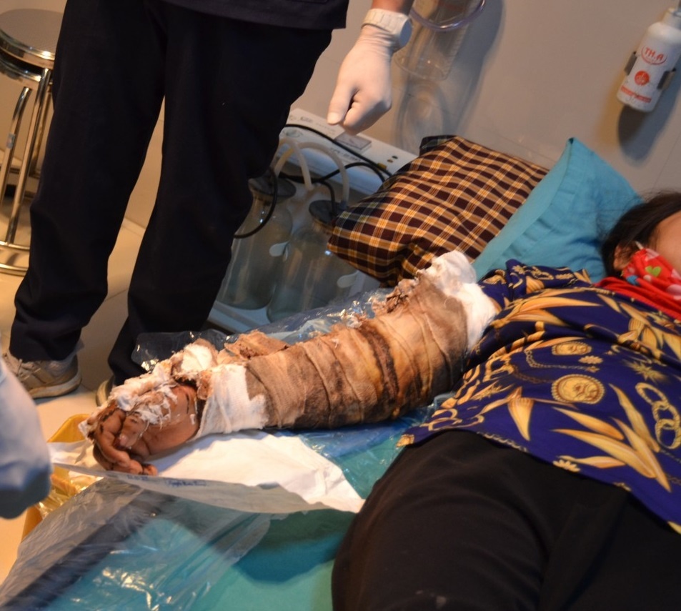 Hoại tử cánh tay vì đắp thuốc nam chữa bỏng ảnh 1 Hoai tu canh tay vi dap thuoc nam chua bong anh 1