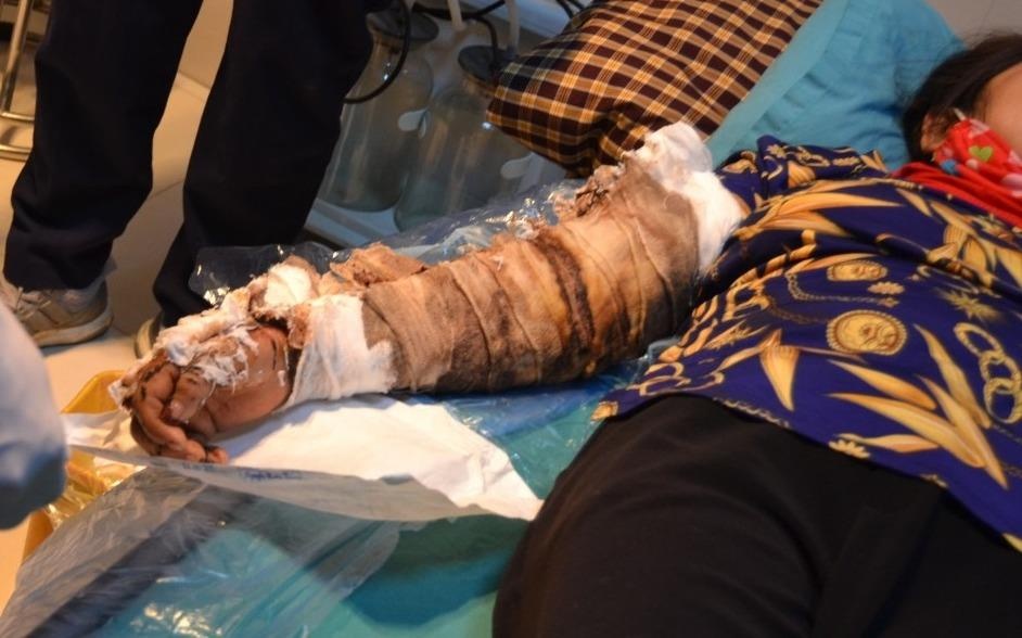 Canh tay nhiem trung, boc mui hoi thoi vi dap thuoc nam chua bong hinh anh