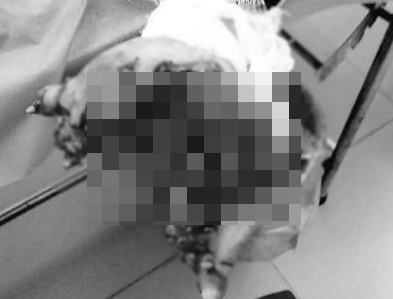 dập nát bàn tay vì vừa dùng điện thoại vừa sạc ảnh 1 dap nat ban tay vi vua dung dien thoai vua sac anh 1