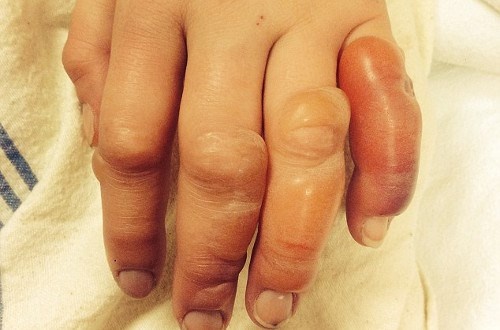 Viec can lam dau tien khi con bi bong de giam dau don hinh anh