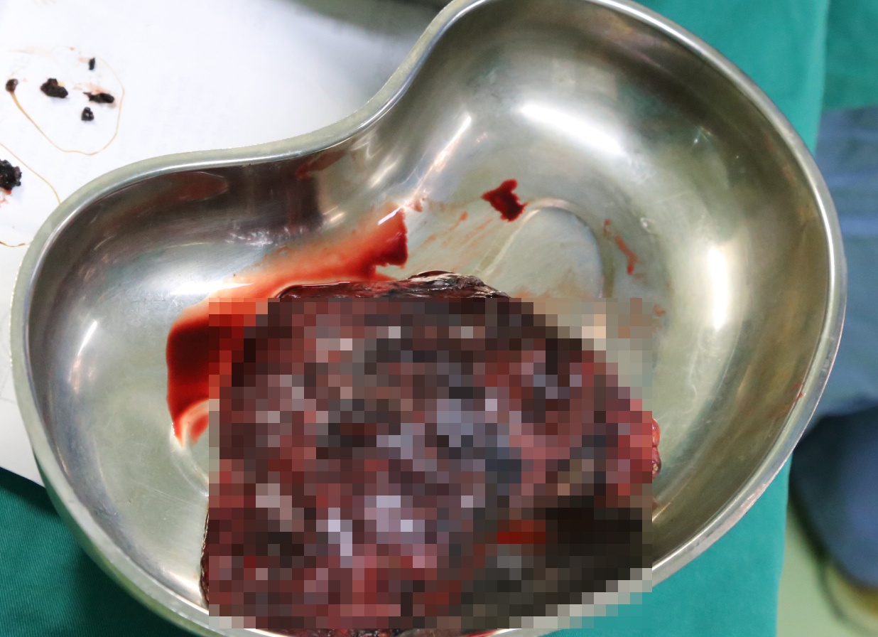 Ung thư phổi ảnh 1 Ung thu phoi anh 1