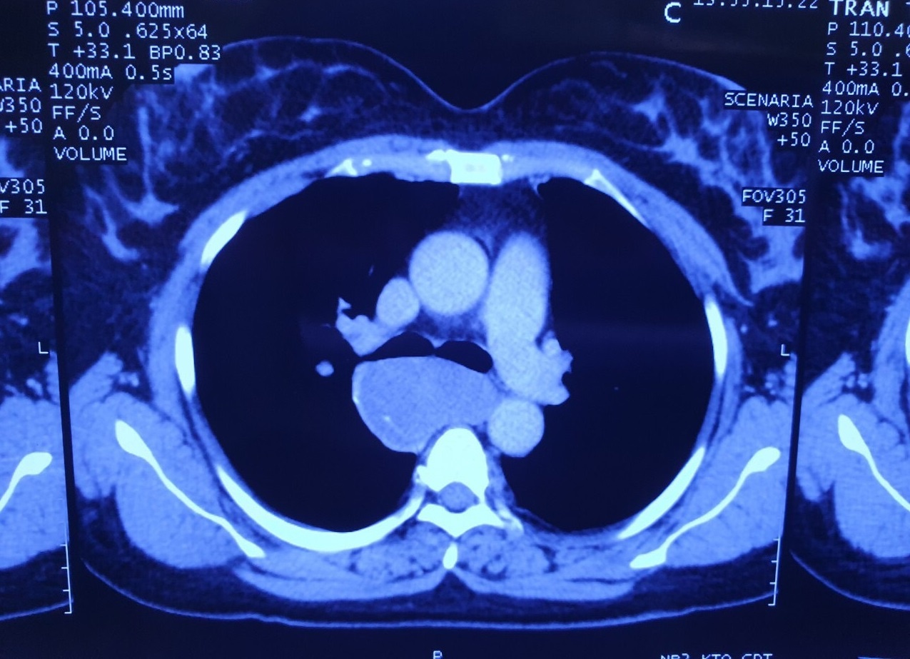 tu y uong thuoc nam dieu tri u thuc quan anh 2